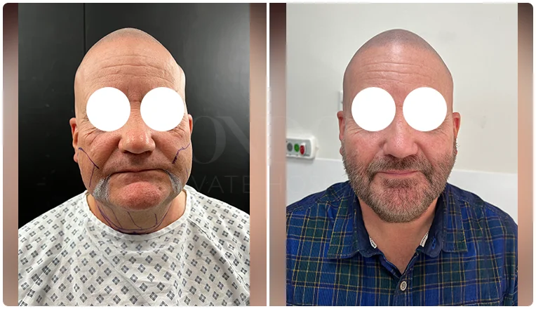 chin vaser liposuction before and after patient -13