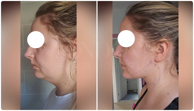 facial vaser liposuction before and after patient -11