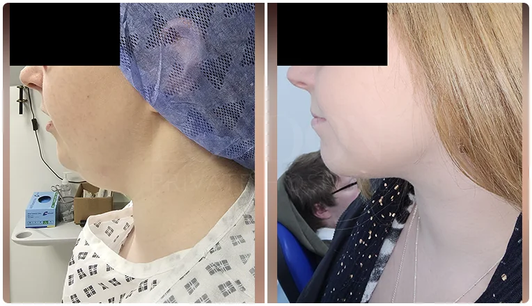 facial vaser liposuction before and after patient -12-v1