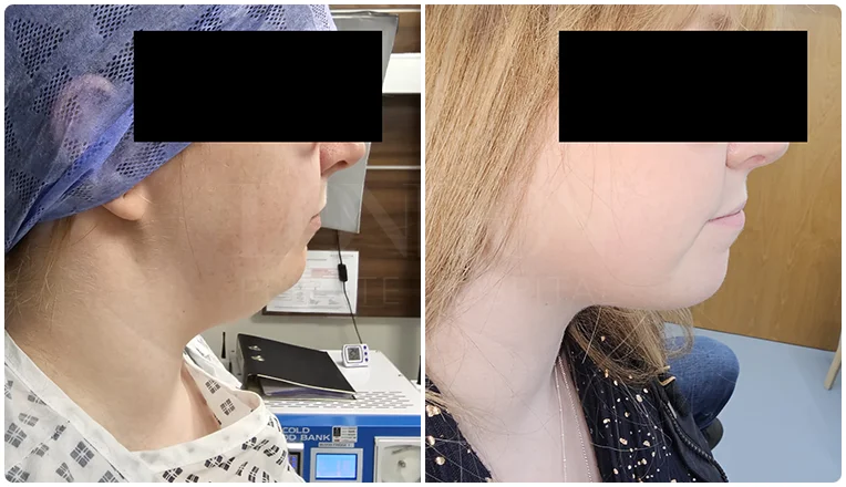 facial vaser liposuction before and after patient -12-v2