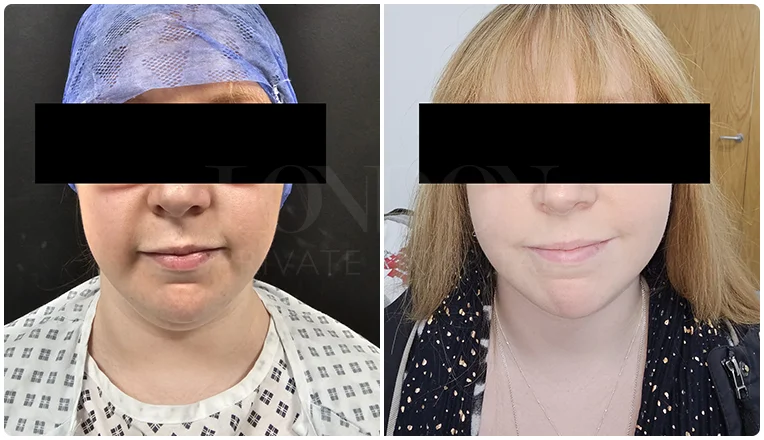 facial vaser liposuction before and after patient -12