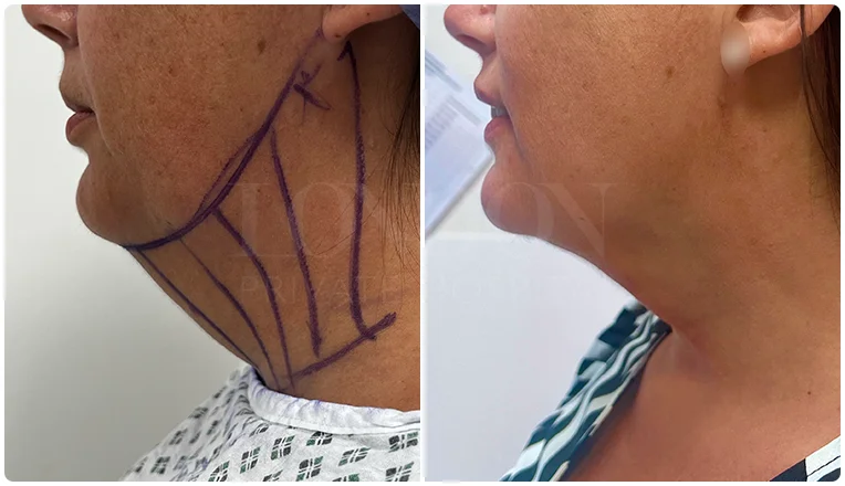 facial vaser liposuction before and after patient -16-v1