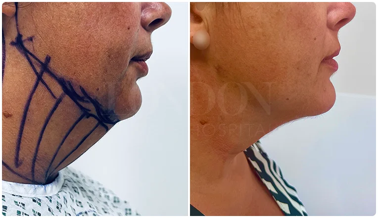 facial vaser liposuction before and after patient -16-v2