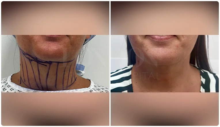 facial vaser liposuction before and after patient -16