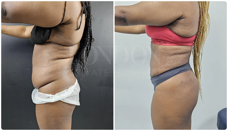 vaser lipo female abs before and after patient result -15-v1