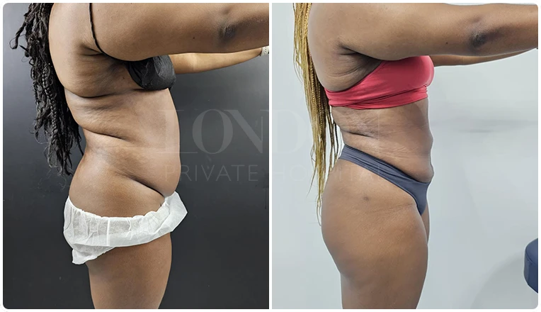 vaser lipo female abs before and after patient result -15