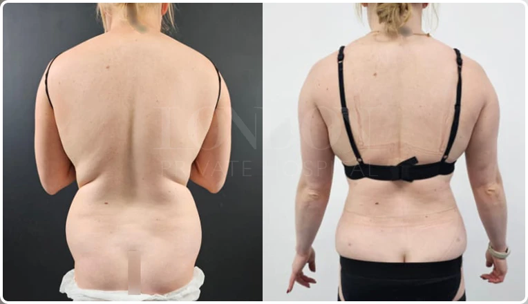 back vaser liposuction before and after patient result