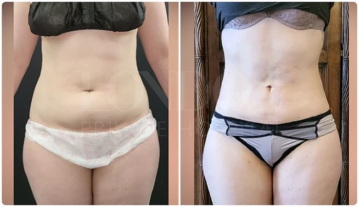 Before and after results of Vaser liposuction on a patient's abdomen in London.