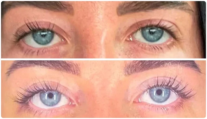  A comparative image showing a woman’s eyes before and after undergoing eyelid 