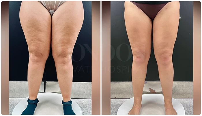 Before and after images showing the results of lipedema surgery in a female patient’s legs.