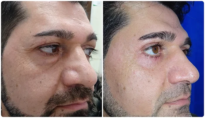 Before and after photos of a male patient who underwent blepharoplasty in London.