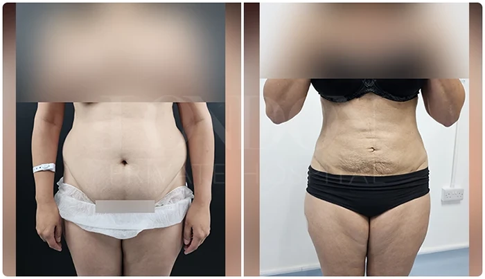 Before and after photos of Vaser liposuction on a female patient.