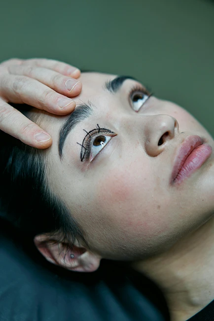 A patient undergoing pre-surgical marking for eyelid surgery.