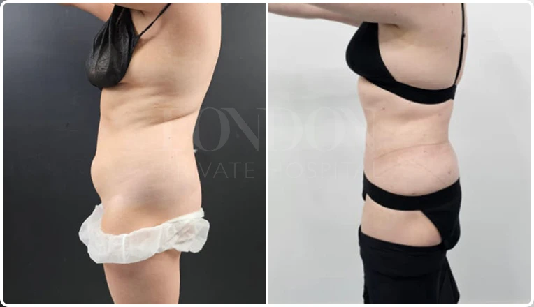 stomach vaser lipo before and after patient result