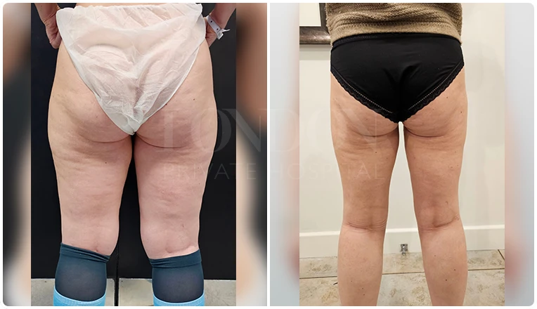 thigh vaser liposuction before and after result