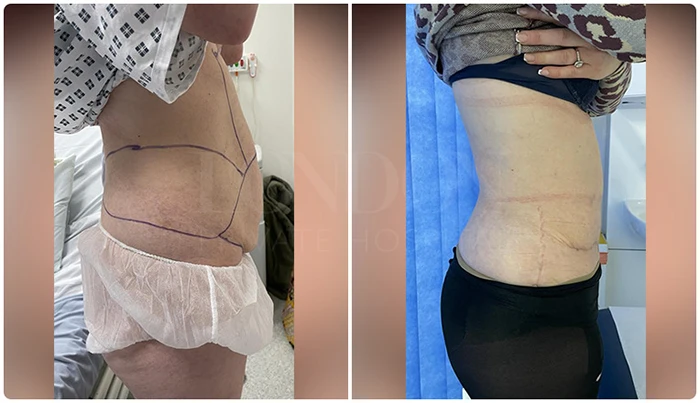 Before and after photos of a tummy tuck surgery, showing significant contour changes.