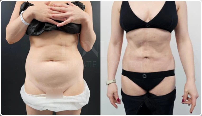 vaser lipo before and after stomach patient result