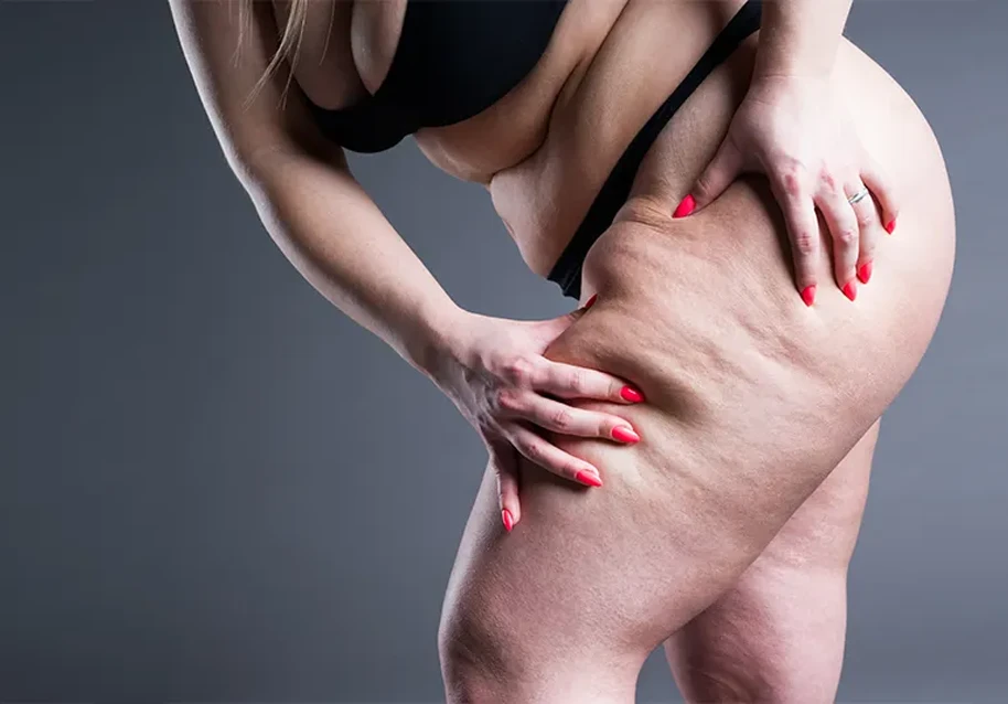 Woman pinching skin on thigh highlighting lipoedema symptoms.