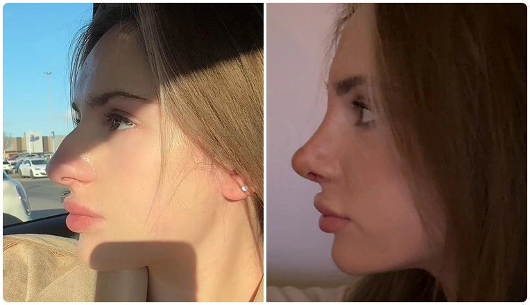 nosejob before and after patient result-10