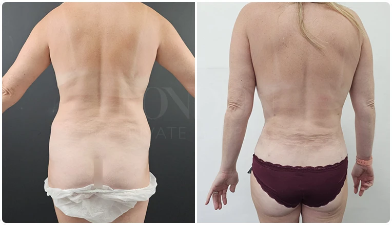 back vaser liposuction before and after patient result-10