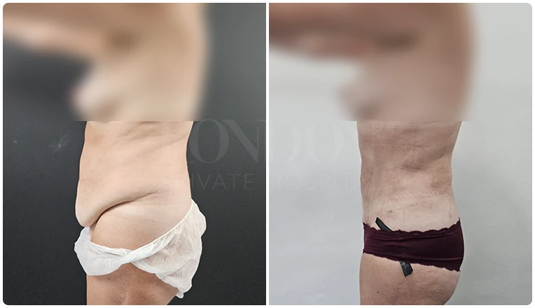 stomach vaser lipo before and after patient result-11-v1