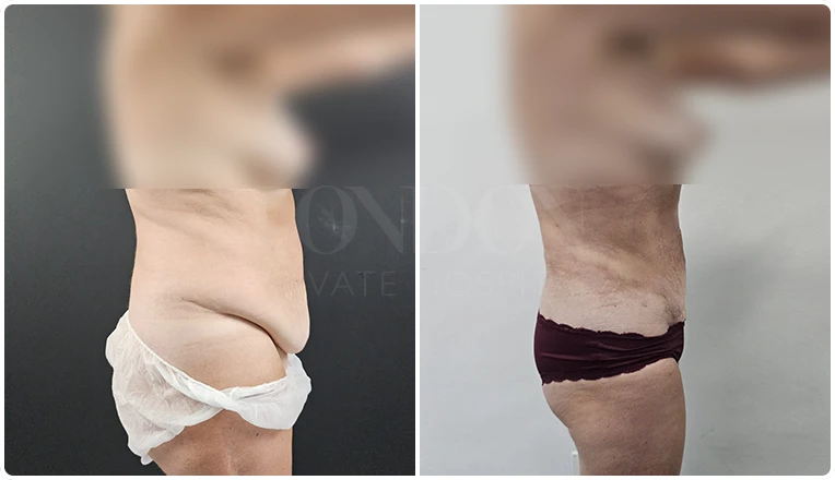 stomach vaser lipo before and after patient result-11-v2