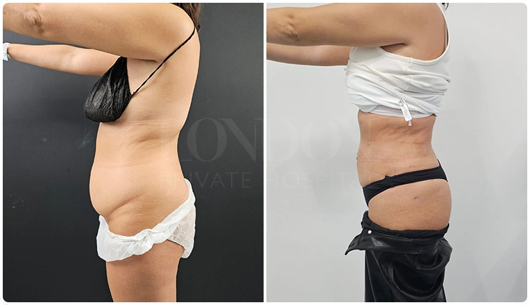 stomach vaser lipo before and after patient result-12-v1