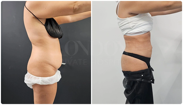 stomach vaser lipo before and after patient result-12