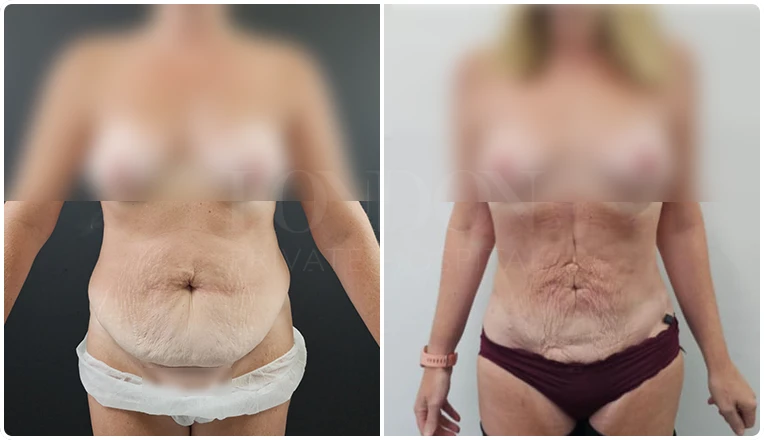 vaser lipo before and after stomach patient result-11