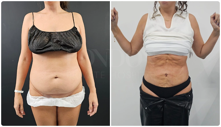 vaser lipo before and after stomach patient result-12