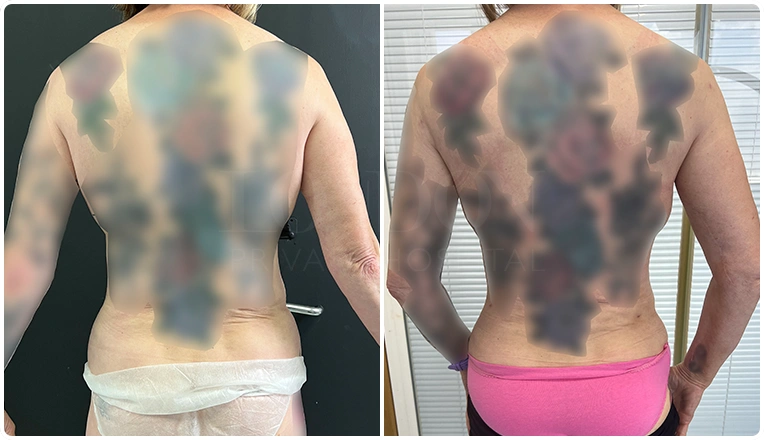 back vaser lipo before and after patient result-22