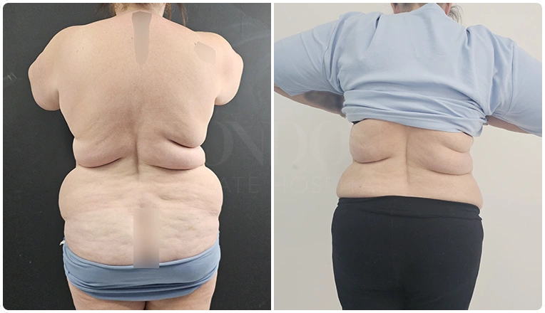 back vaser lipo before and after patient result-24