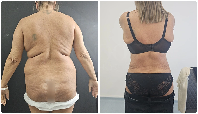 back vaser lipo before and after patient result-25