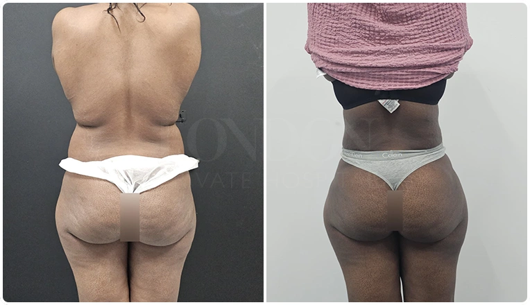 back vaser lipo before and after patient result-26
