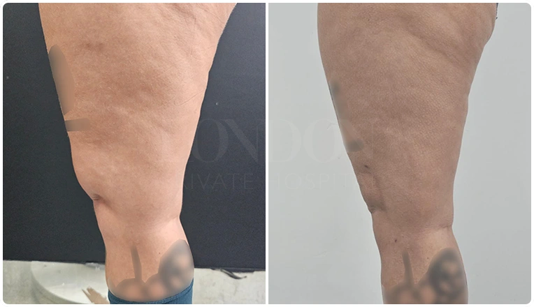 thigh vaser liposuction before after patient - 11