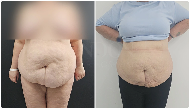 vaser lipo before and after stomach patient result-24