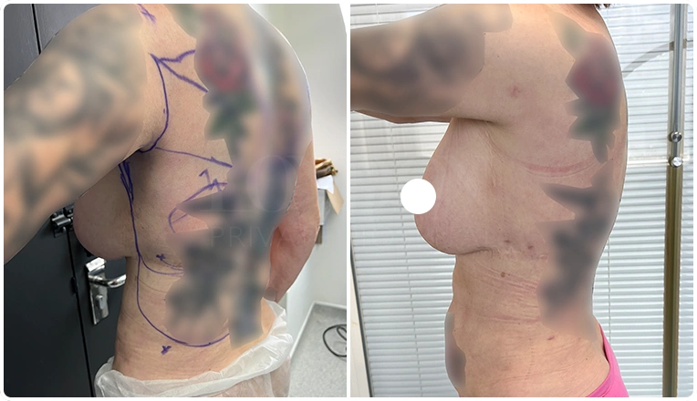 vaser lipo female abs before and after patient result-22-v1