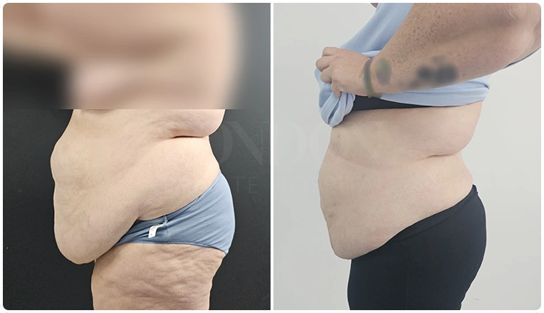 vaser lipo female abs before and after patient result-24-v1