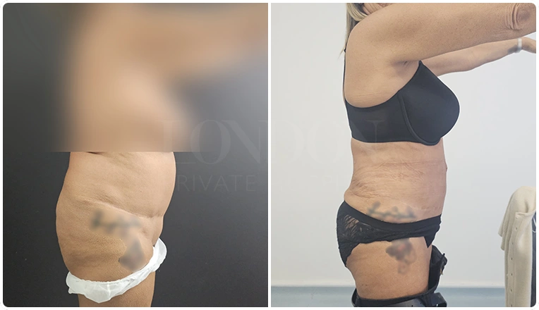 vaser lipo female abs before and after patient result-25-v1