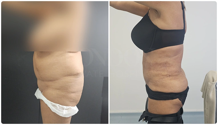 vaser lipo female abs before and after patient result-25