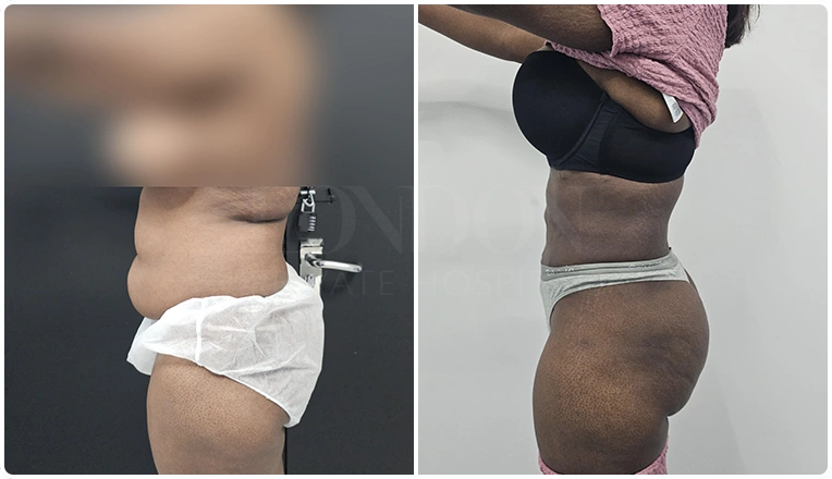 vaser lipo female abs before and after patient result-26-v1
