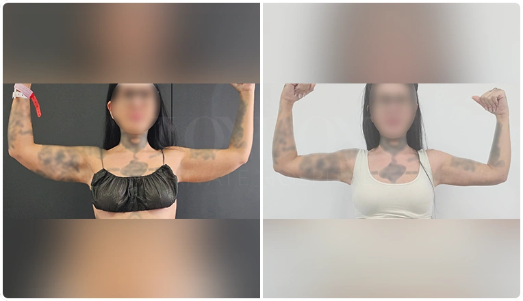 vaser lipo on arms before and after patient-11
