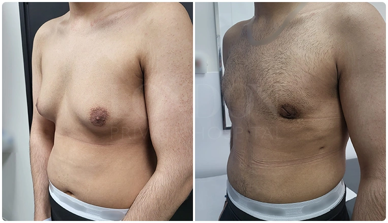gynecomastia before and after patient -8-v1
