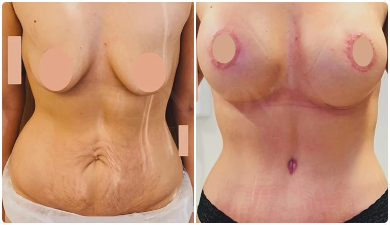 breast enhancement with an uplift and a tummy tuck result