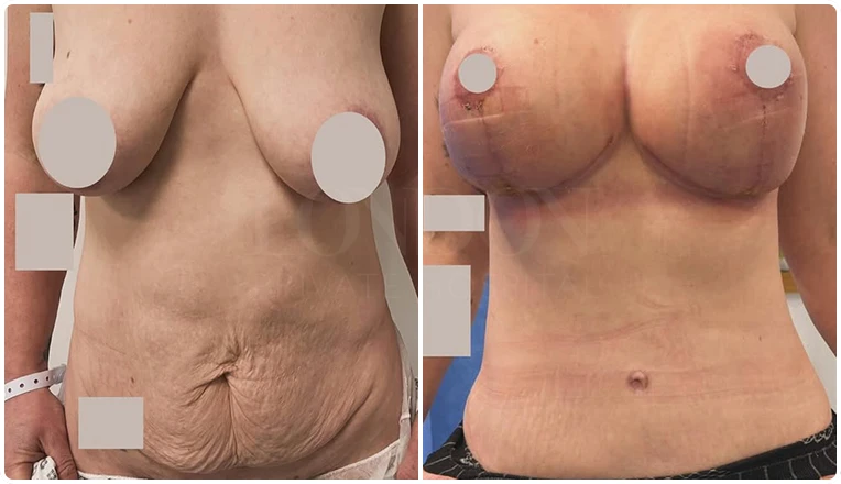 breast lift and tummy tuck result