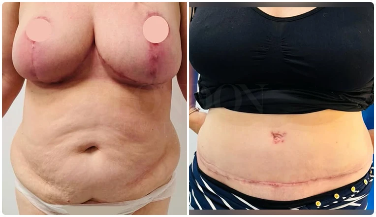 breast reduction, full tummy tuck and vaser liposuction result