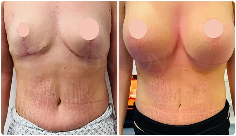 breast uplift and new breast augmentation plus tummy tuck-vaser liposuction result