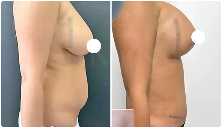 mummy makeover with tummy tuck and breast augmentation result-v1