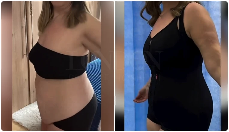 mummy makeover with tummy tuck vaser lipo and breast augmentation result-1-v1