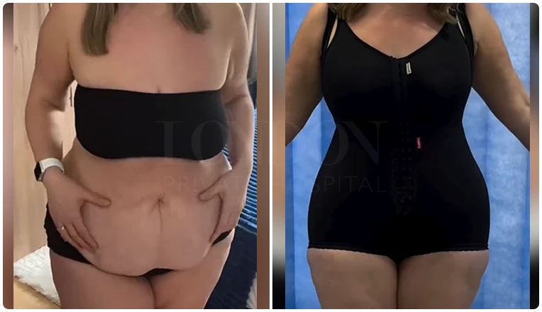 mummy makeover with tummy tuck vaser lipo and breast augmentation result-1